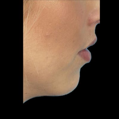 Chin Filler Before & After Gallery - Patient 333983 - Image 1