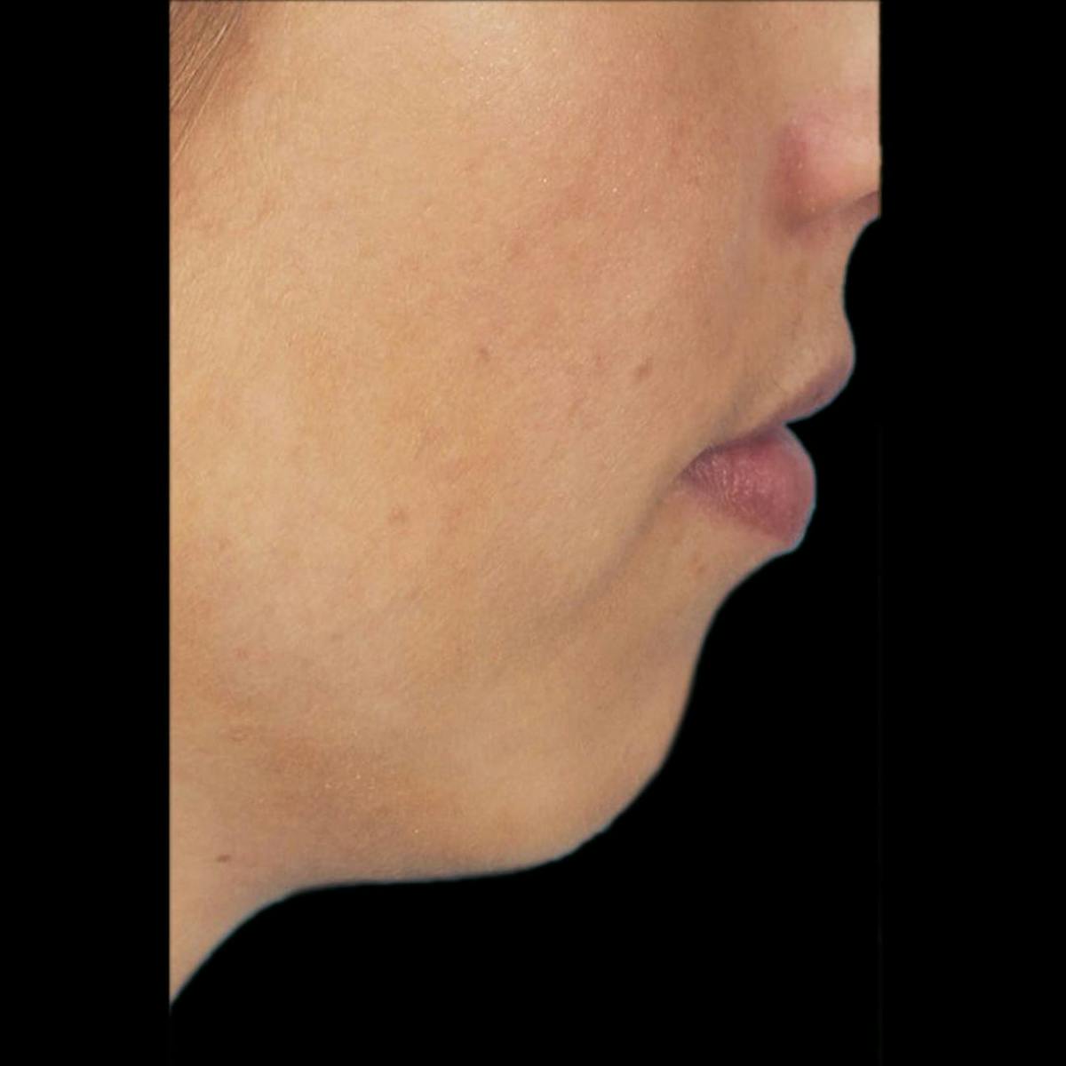 Chin Filler Before & After Gallery - Patient 333983 - Image 2