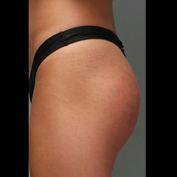 Sculptra Before & After Gallery - Patient 339281 - Image 1