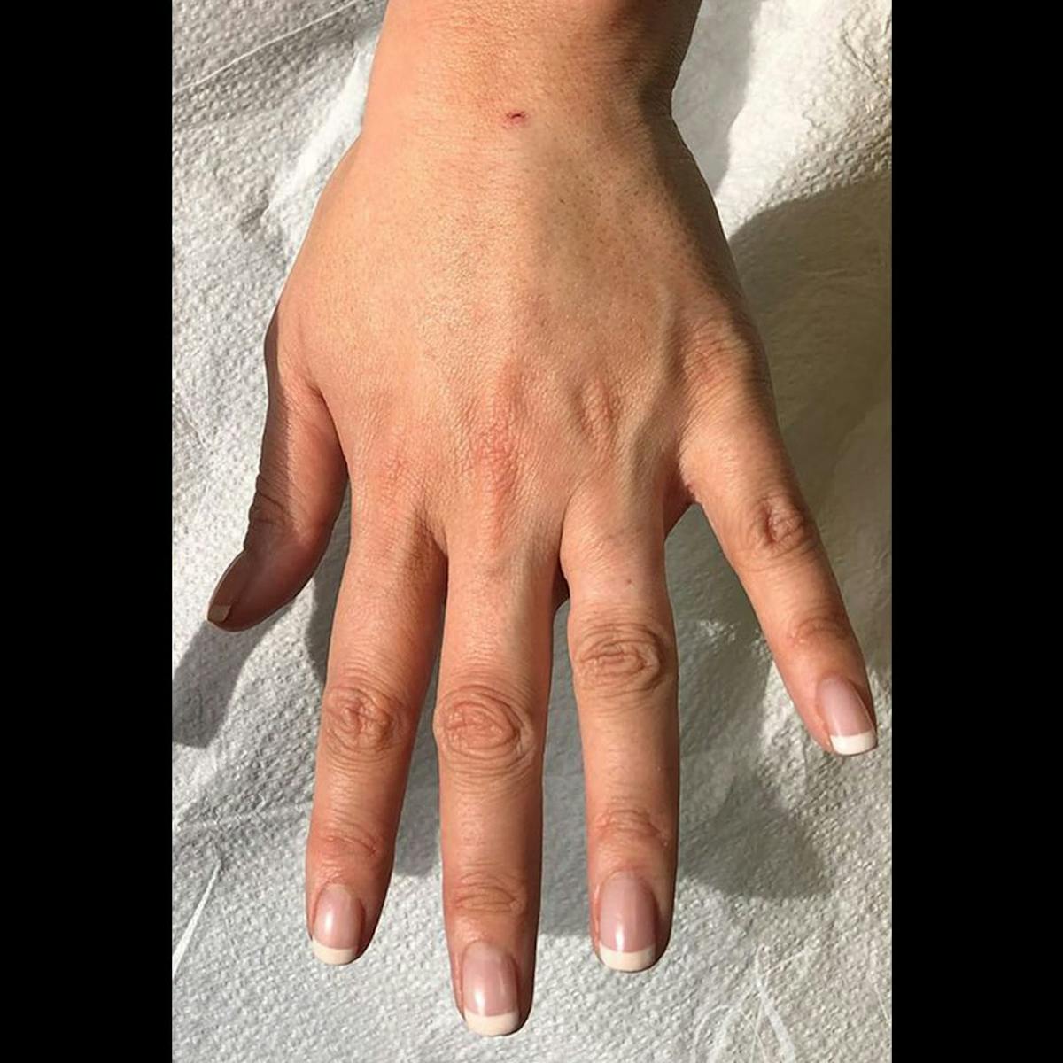 Sculptra Before & After Gallery - Patient 357844 - Image 1