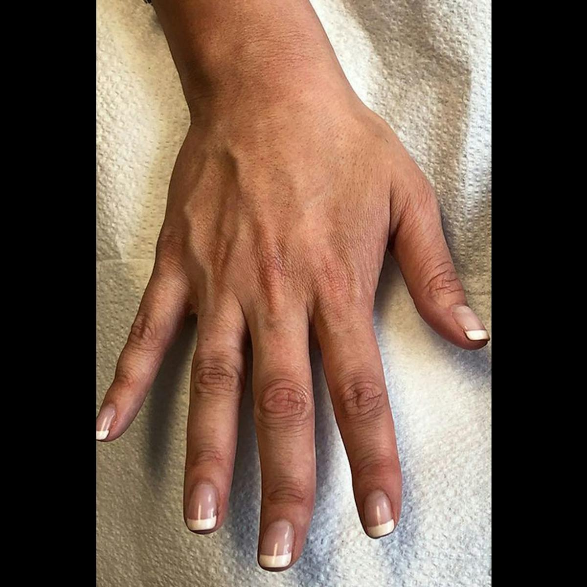 Sculptra Before & After Gallery - Patient 357844 - Image 2