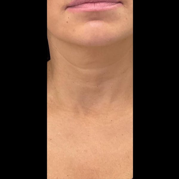 Sculptra Before & After Gallery - Patient 211420 - Image 1