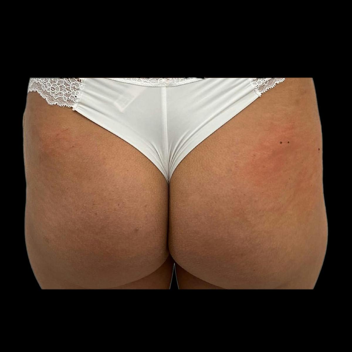 Sculptra Before & After Gallery - Patient 272916 - Image 1