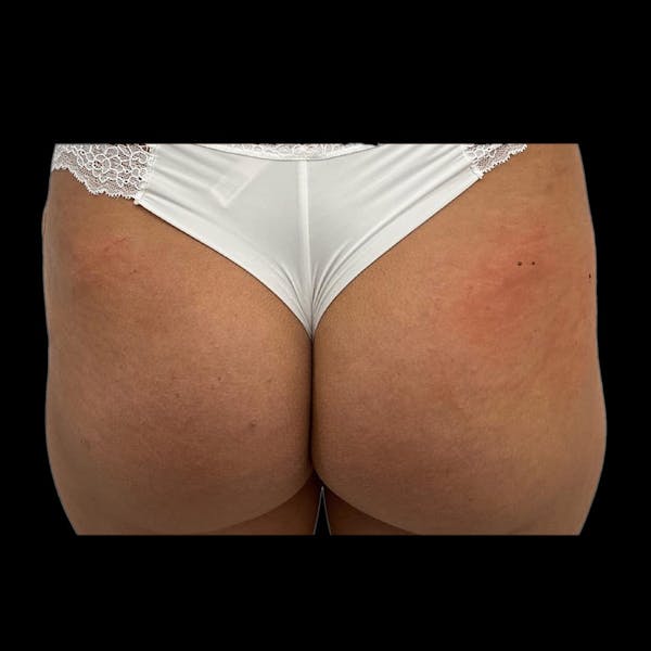Sculptra Before & After Gallery - Patient 272916 - Image 1