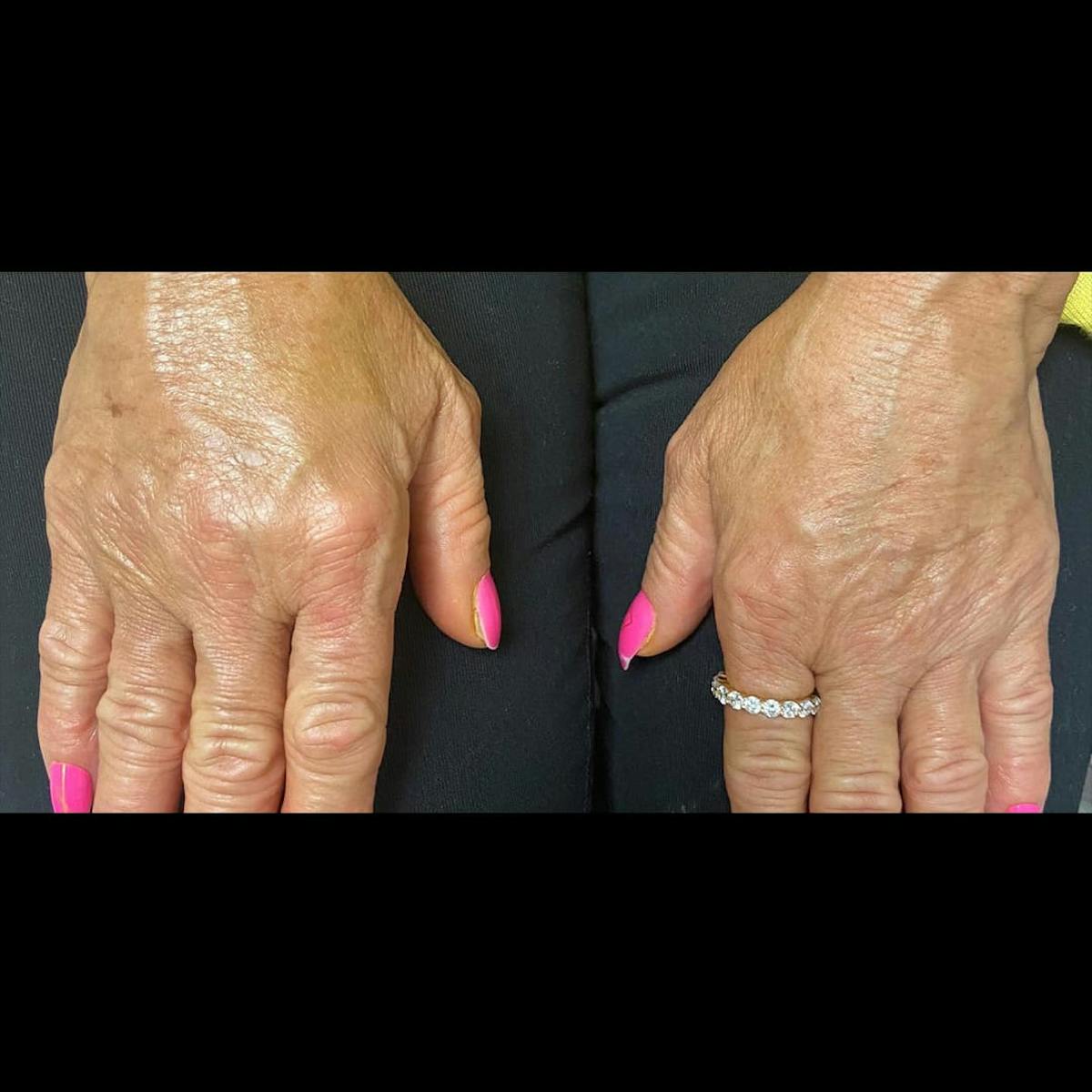Sculptra Before & After Gallery - Patient 166991 - Image 1
