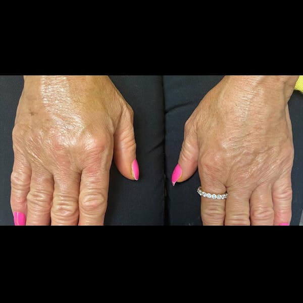 Sculptra Before & After Gallery - Patient 166991 - Image 1