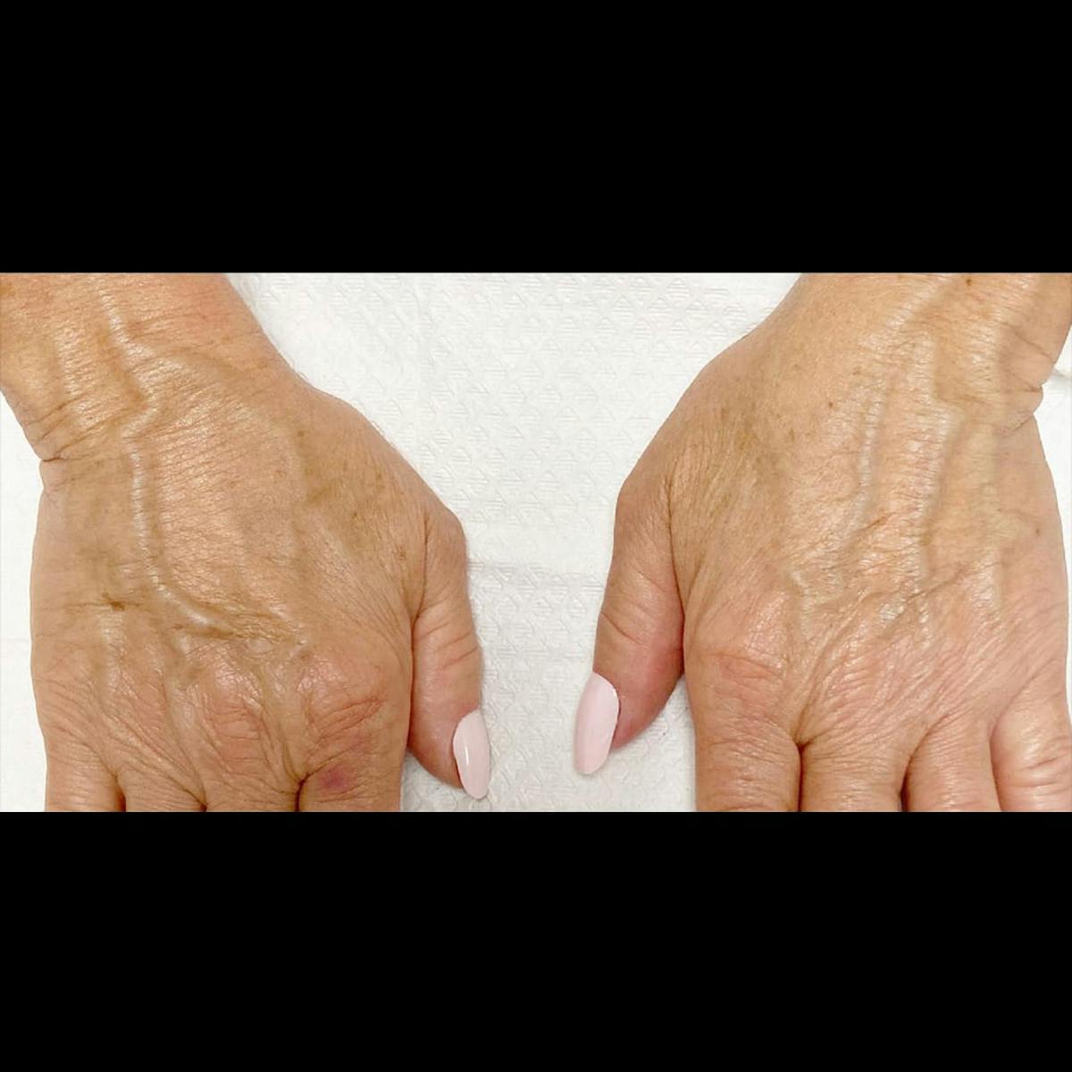 Sculptra Before & After Gallery - Patient 166991 - Image 2
