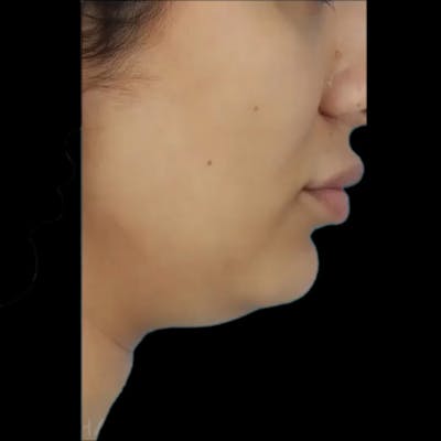 Kybella Before & After Gallery - Patient 424363 - Image 1