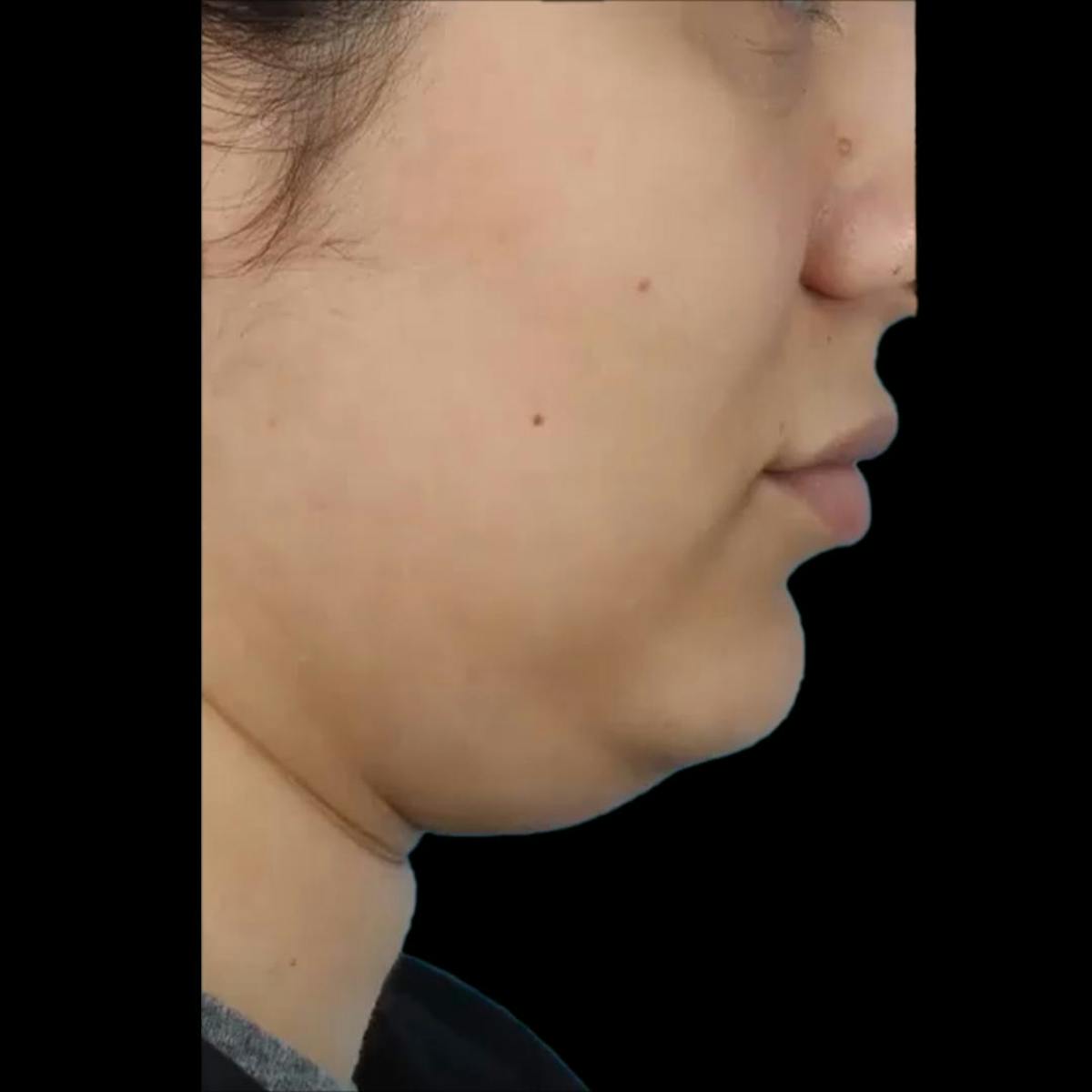 Kybella Before & After Gallery - Patient 424363 - Image 2