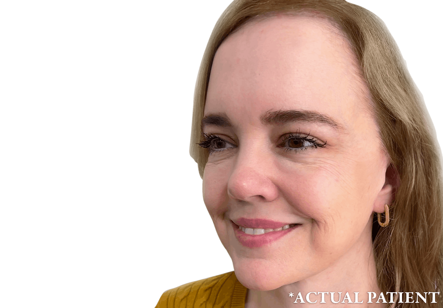 A facelift patient
