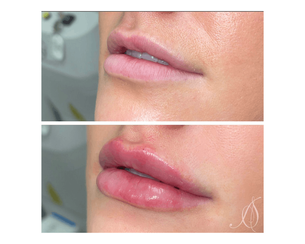 actual patient - lip filler before and after
