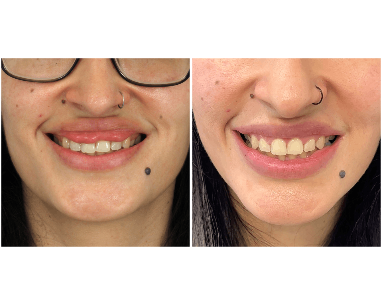 actual patient - lip reduction before and after