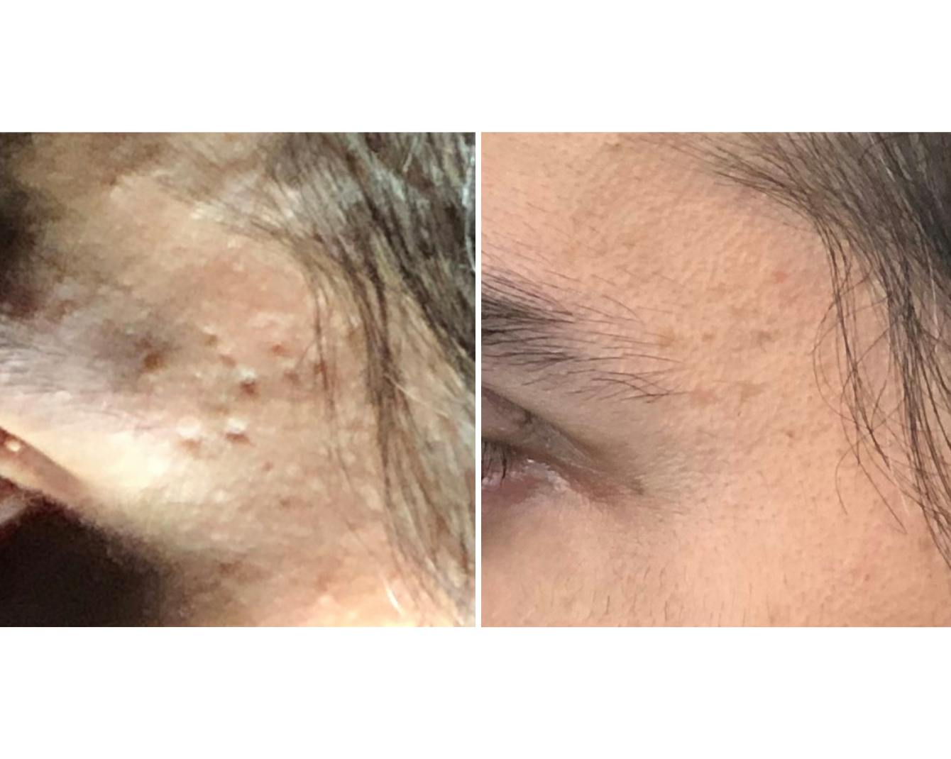 actual patient - before and after treatment