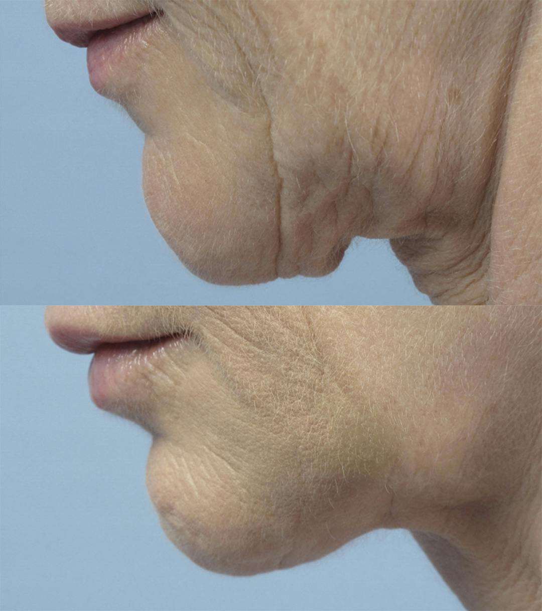 Facetite before and after from actual patient