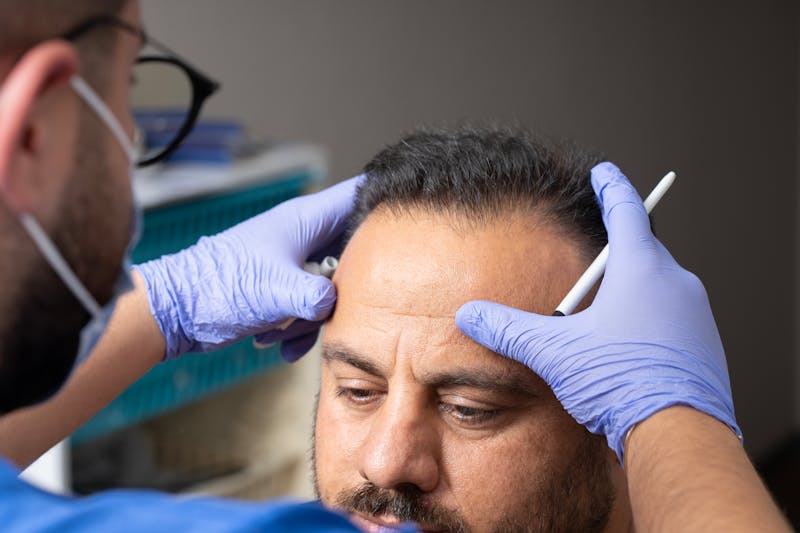 A doctor wearing blue gloves holding the patient’s head and trying to identify the area for the hair transplant.