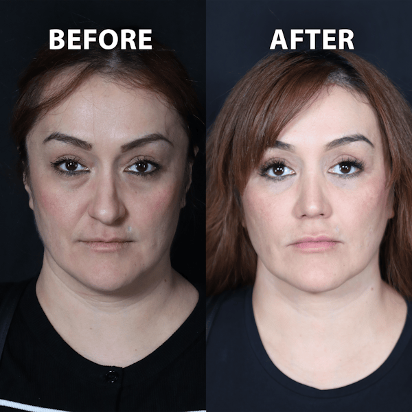 Blepharoplasty Before & After Gallery - Patient 263284 - Image 1