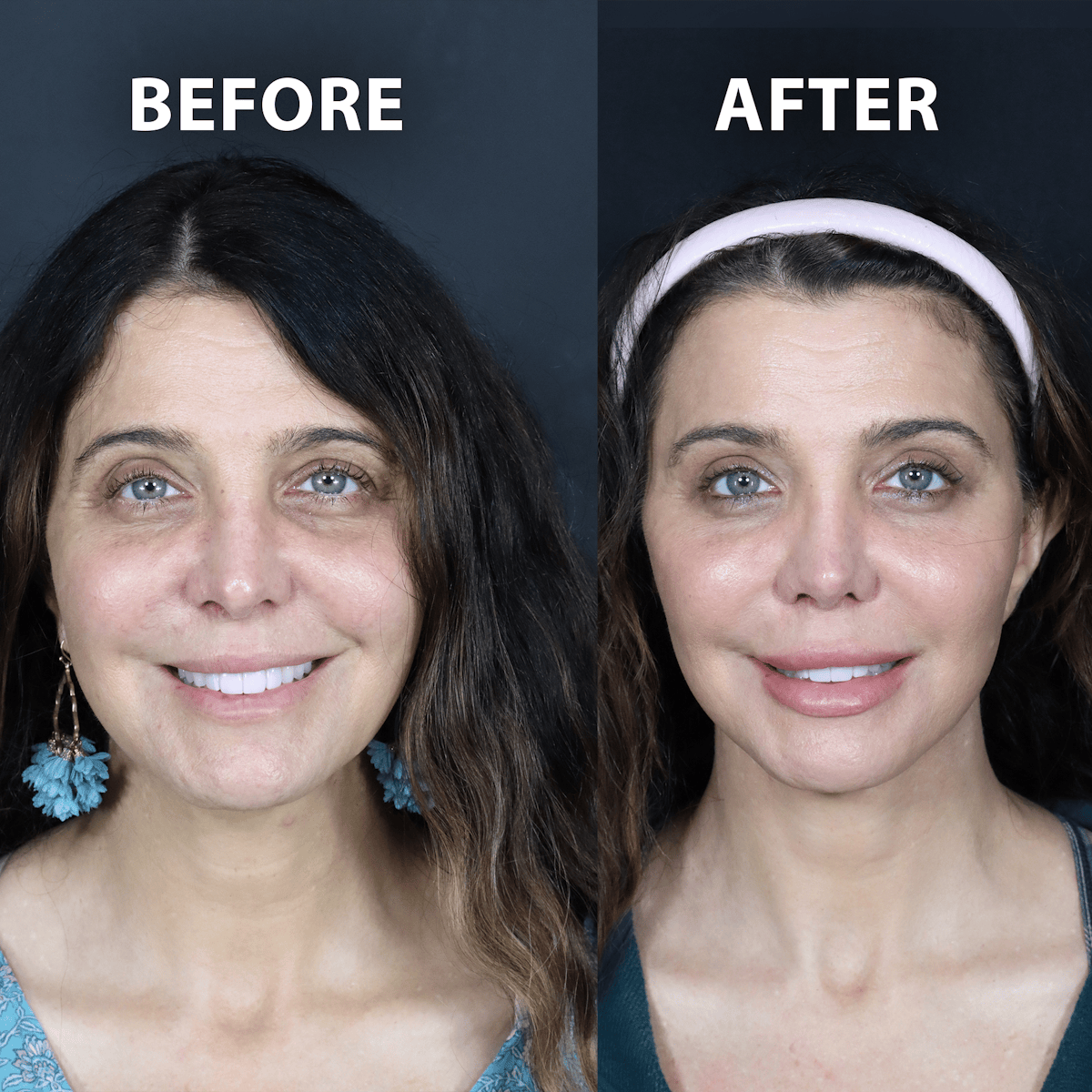 Blepharoplasty Before & After Gallery - Patient 199076 - Image 1
