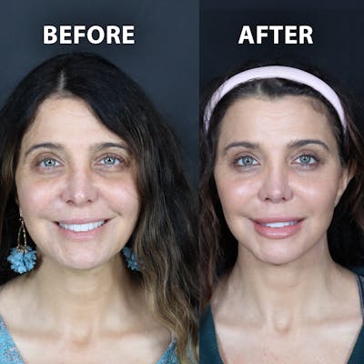 Blepharoplasty Before & After Gallery - Patient 199076 - Image 1