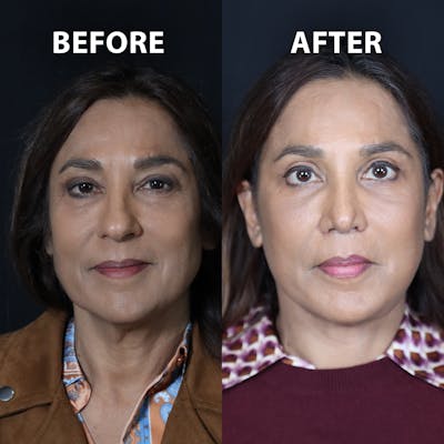 Blepharoplasty Before & After Gallery - Patient 276548 - Image 1
