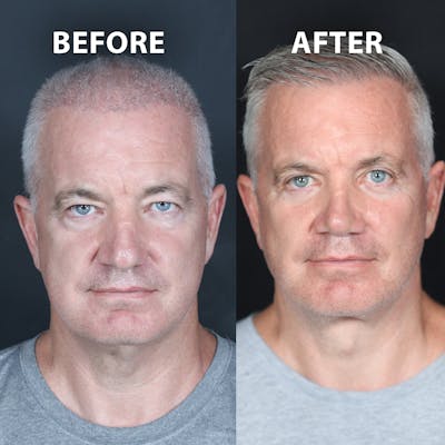 Blepharoplasty Before & After Gallery - Patient 827745 - Image 1