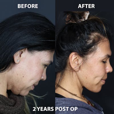 Before & Afters Before & After Gallery - Patient 384911 - Image 1