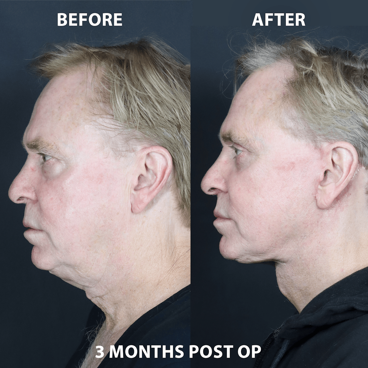 Before & Afters Before & After Gallery - Patient 128007 - Image 1