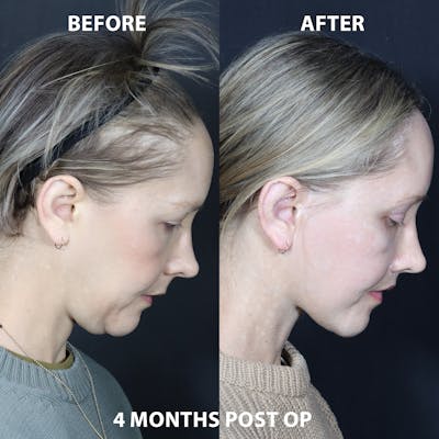 Before & Afters Before & After Patient YRvaKScJQ5qovgThrCTAXA