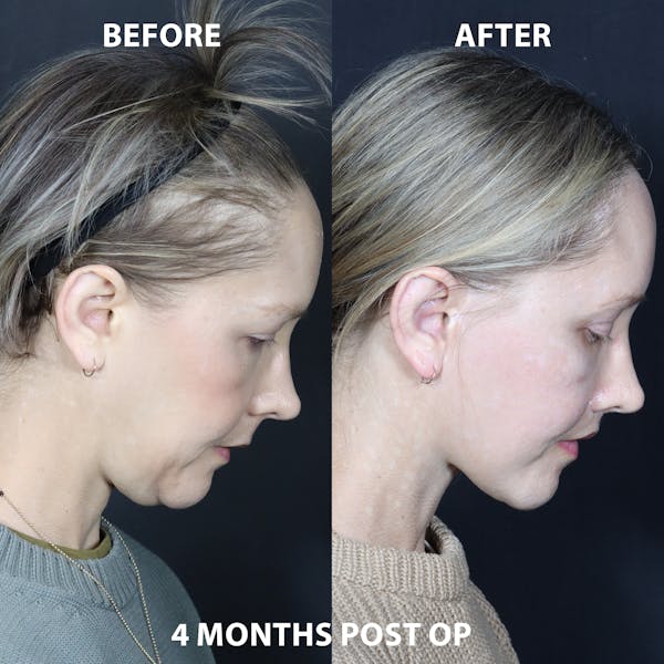 Before & Afters Before & After Gallery - Patient 113835 - Image 1