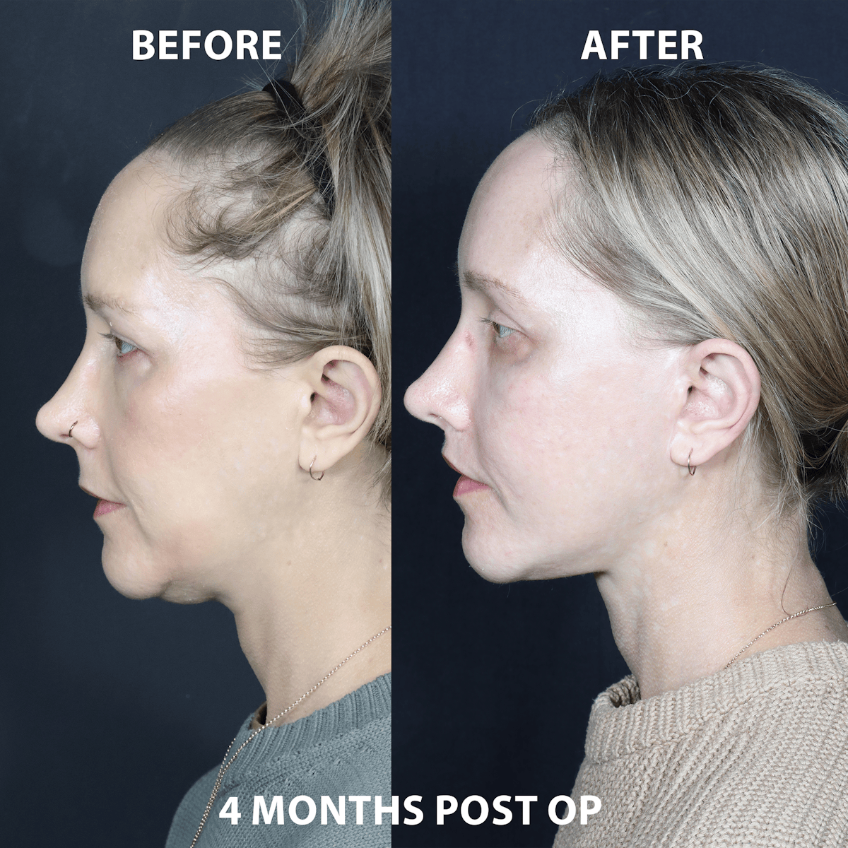 Before & Afters Before & After Gallery - Patient 113835 - Image 2