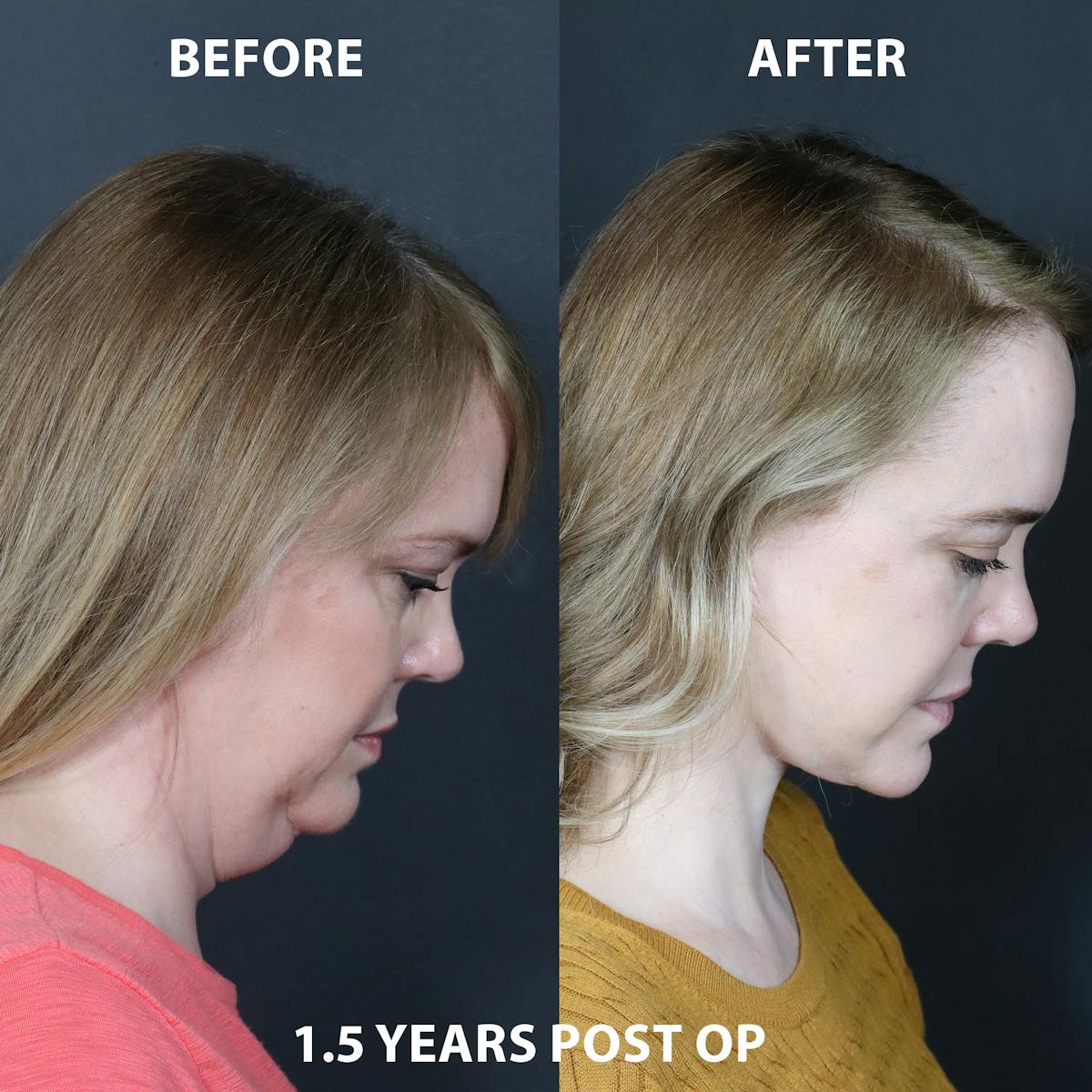 Before & Afters Before & After Gallery - Patient 147697 - Image 2
