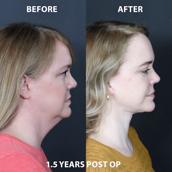 Before & Afters Before & After Gallery - Patient 147697 - Image 1