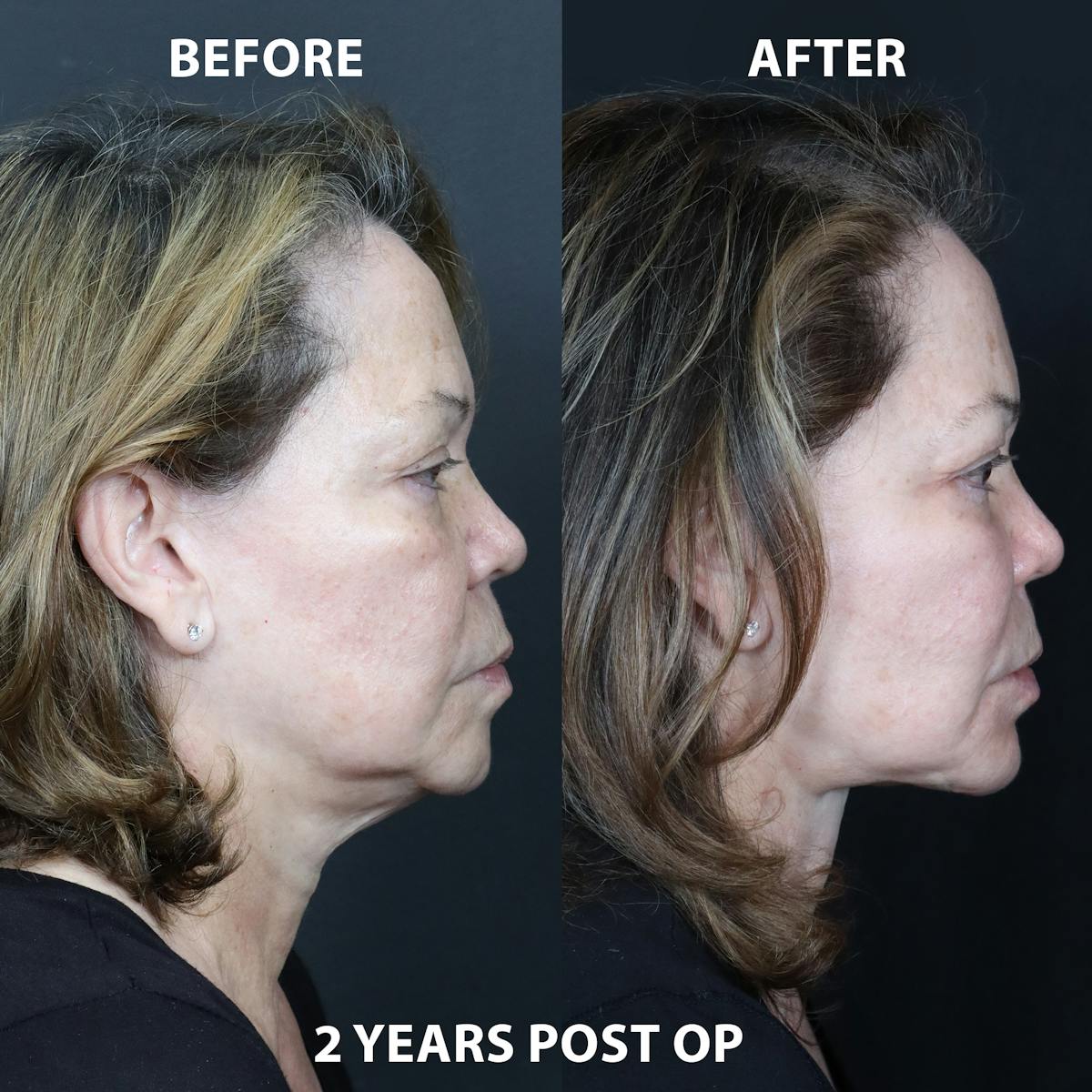 Before & Afters Before & After Gallery - Patient 399855 - Image 1