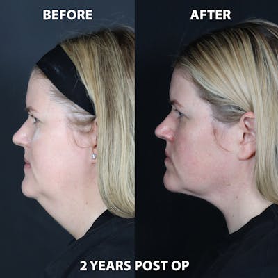 Neck Only Before & After Gallery - Patient 416116 - Image 1