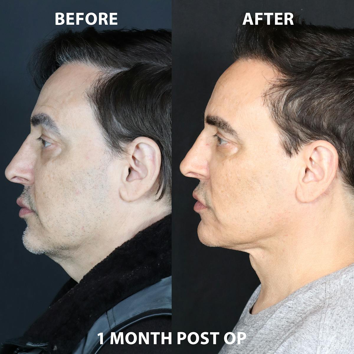 Neck Only Before & After Gallery - Patient 902032 - Image 1