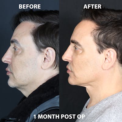 Neck Only Before & After Gallery - Patient 902032 - Image 1