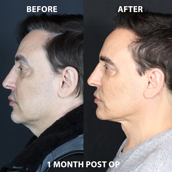 Neck Only Before & After Gallery - Patient 902032 - Image 1