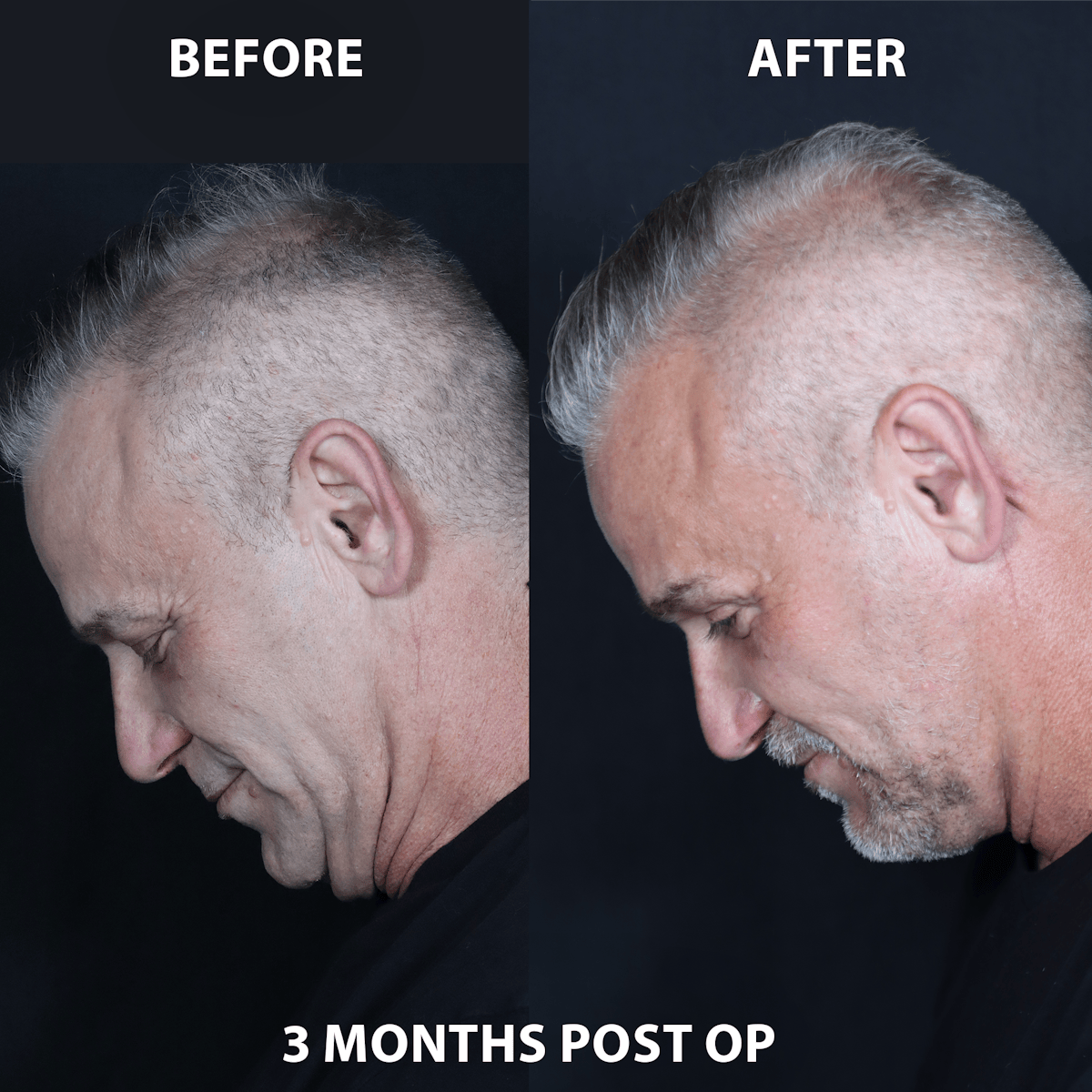 Neck Only Before & After Gallery - Patient 101312 - Image 2