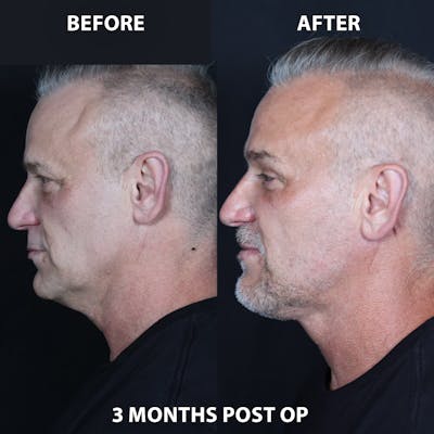 Neck Only Before & After Gallery - Patient 101312 - Image 1