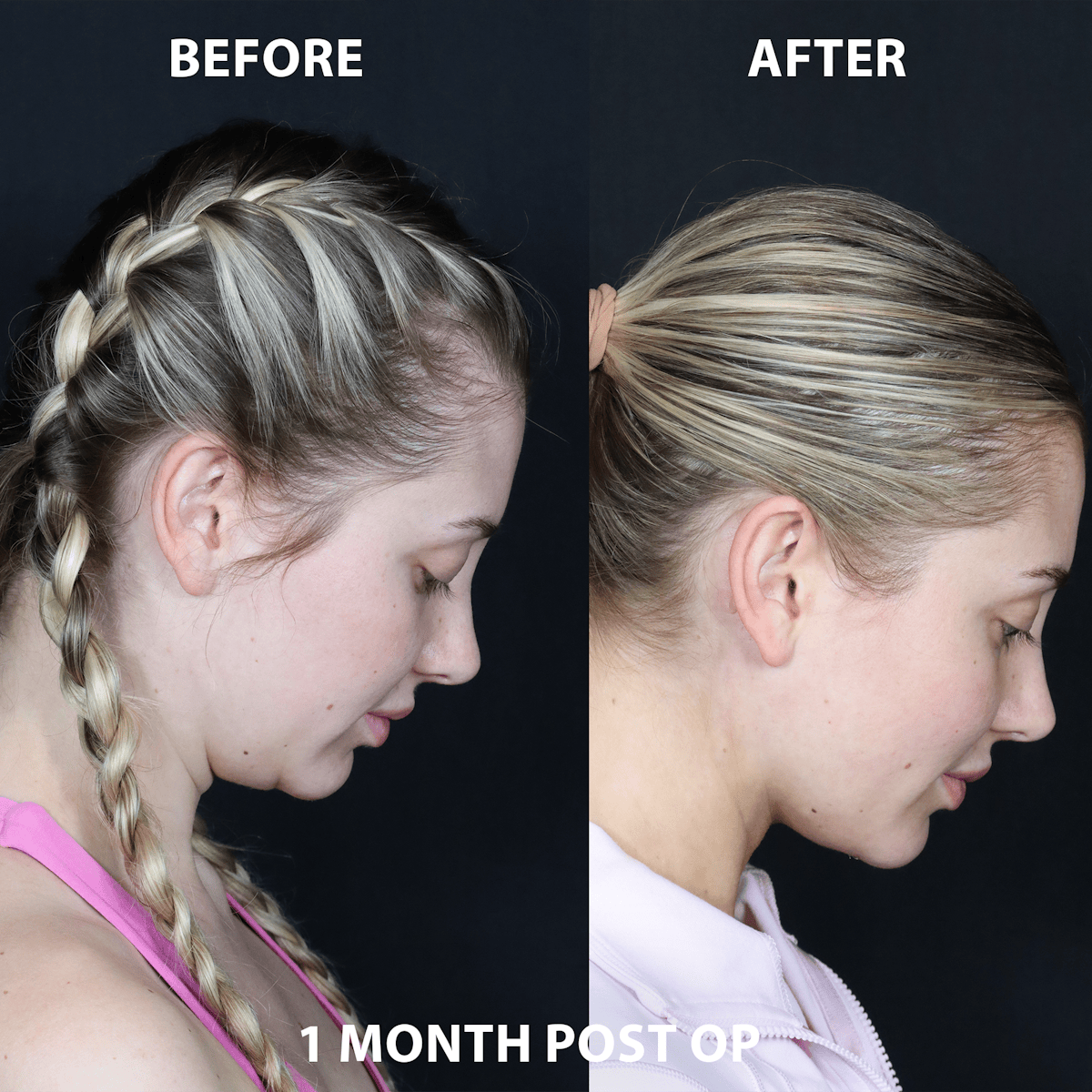 Neck Only Before & After Gallery - Patient 184152 - Image 1