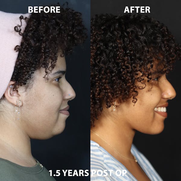 Neck Only Before & After Gallery - Patient 326512 - Image 1