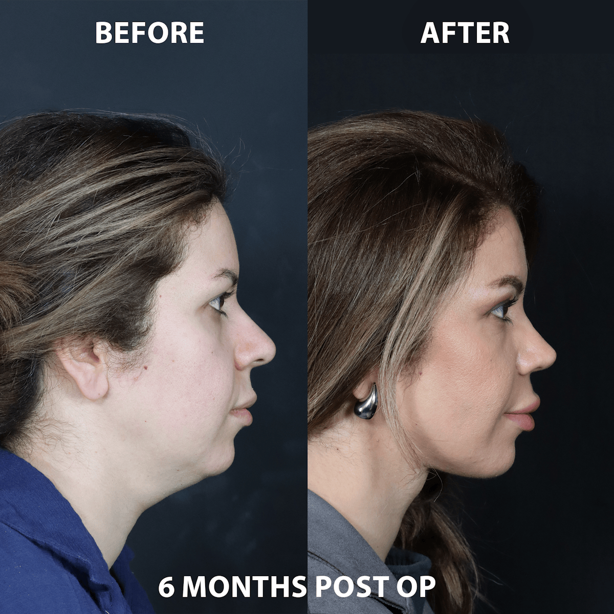 Neck Only Before & After Gallery - Patient 262397 - Image 1