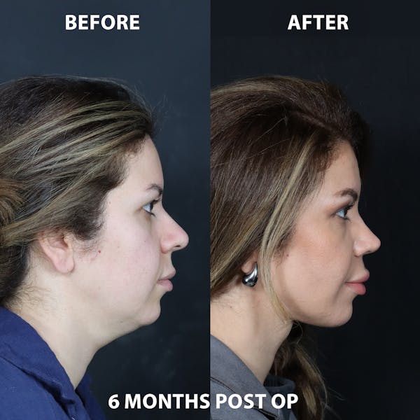 Neck Only Before & After Gallery - Patient 262397 - Image 1