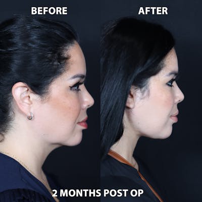 Neck Only Before & After Gallery - Patient 244356 - Image 1