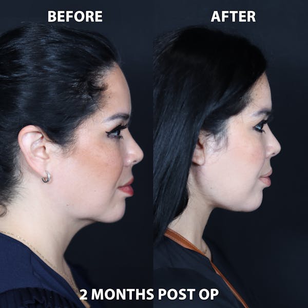 Neck Only Before & After Gallery - Patient 244356 - Image 1
