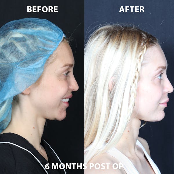 Neck Only Before & After Gallery - Patient 274118 - Image 1