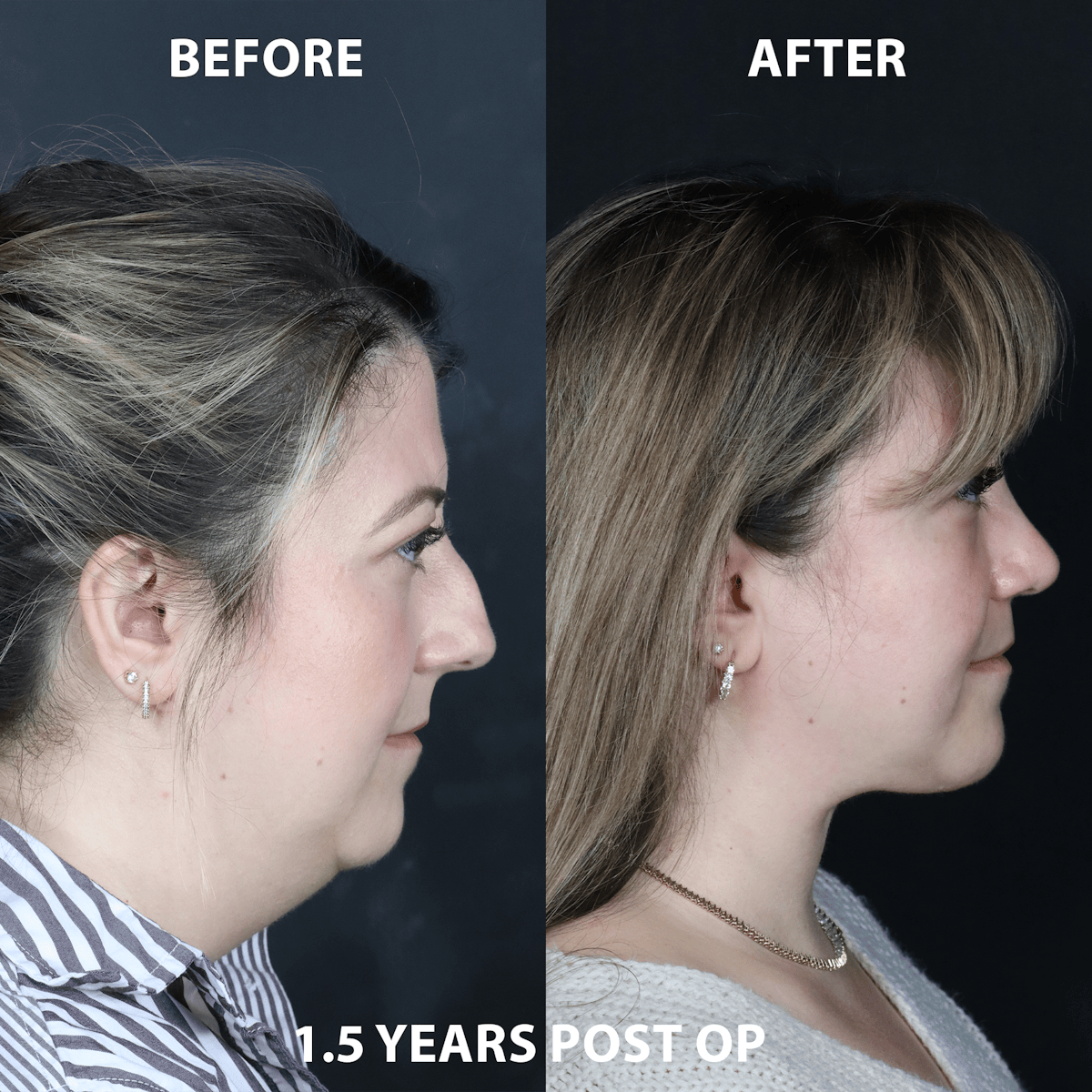 Neck Only Before & After Gallery - Patient 623942 - Image 1