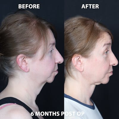 Neck Only Before & After Gallery - Patient 395016 - Image 1