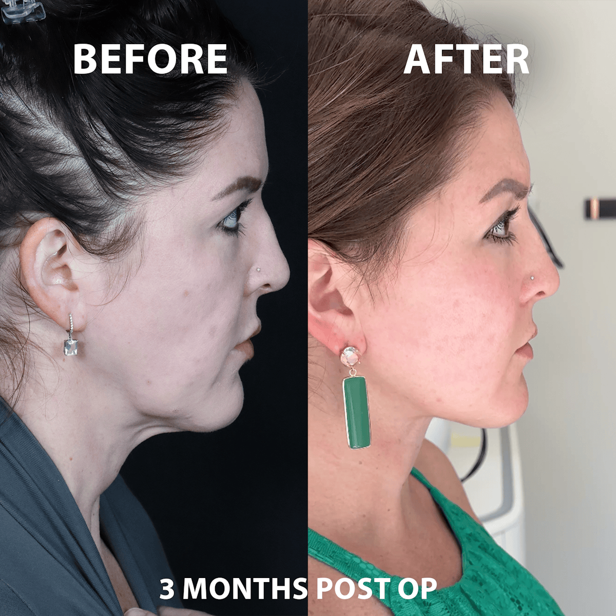 Mini Facelift Before & After Gallery - Patient 726334 - Image 1