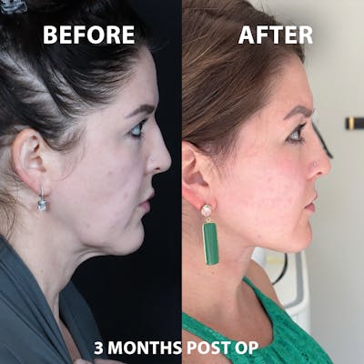 Mini Facelift Before & After Gallery - Patient 726334 - Image 1