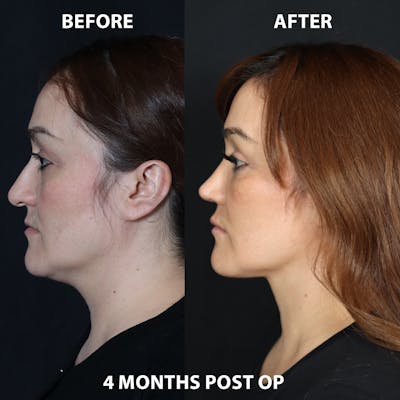 Mini Facelift Before & After Gallery - Patient 202338 - Image 1